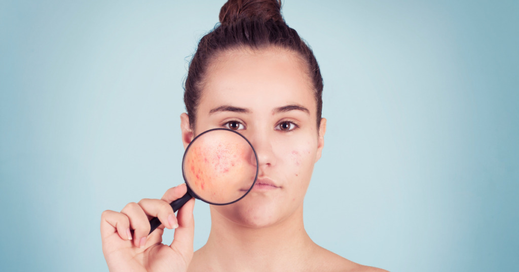 Treating Fungal Facial Acne: Causes, Symptoms, and Effective Remedies