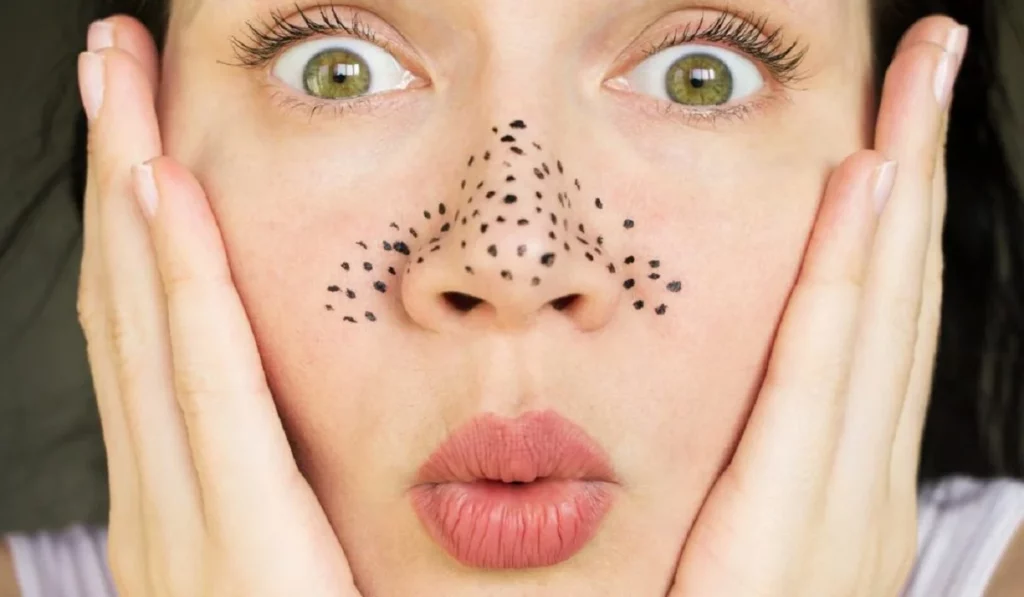 5 Secrets To Achieving Blackhead Free Skin