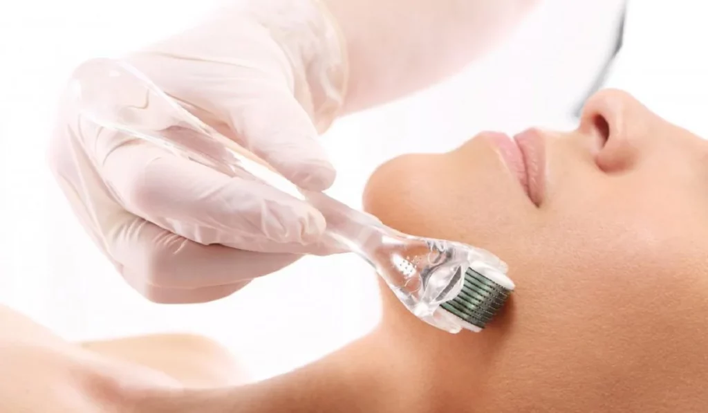 What Is Microneedling Everything Youneed To Know